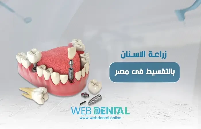 زراعة الاسنان بالتقسيط فى مصر image
