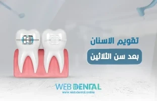 تقويم الاسنان بعد سن الثلاثين image