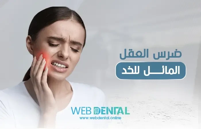 ضرس العقل المائل للخد image