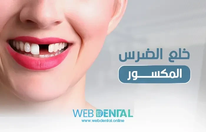 خلع الضرس المكسور image