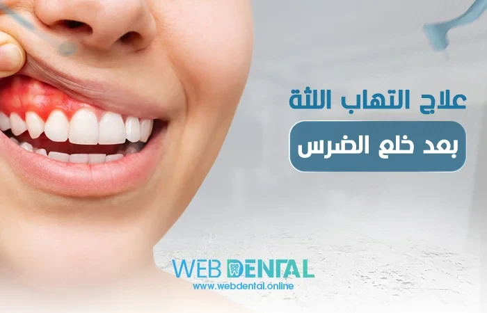 علاج التهاب اللثة بعد خلع الضرس image