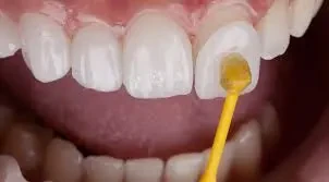 ما هو فينير الاسنان؟ image
