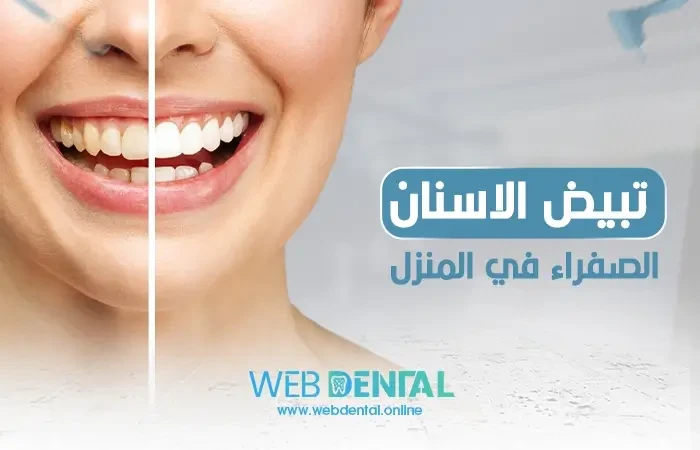 تبيض الاسنان الصفراء في المنزل image