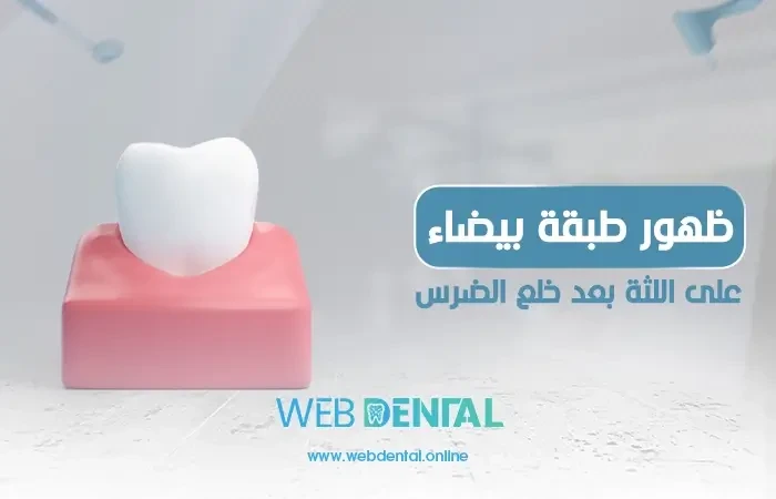 ظهور طبقة بيضاء على اللثة بعد خلع الضرس| متى يكون خطير؟ image