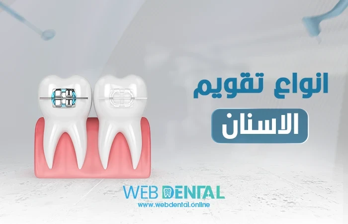 اهم وأفضل انواع تقويم الاسنان في مصر image