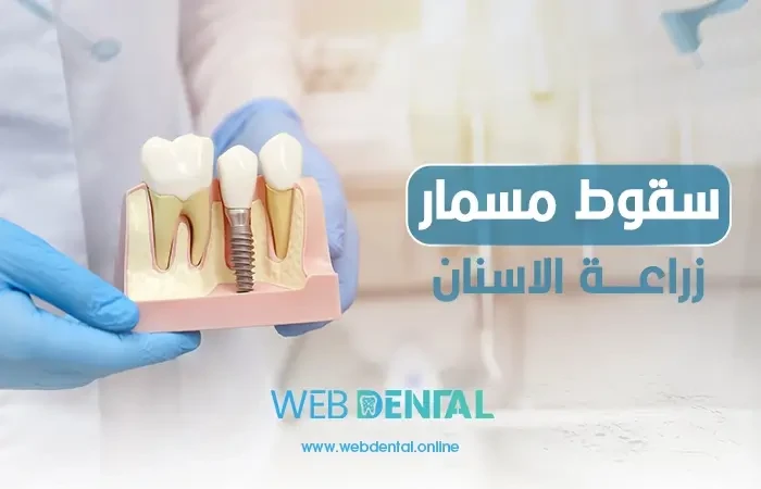 سقوط مسمار زراعة الاسنان image