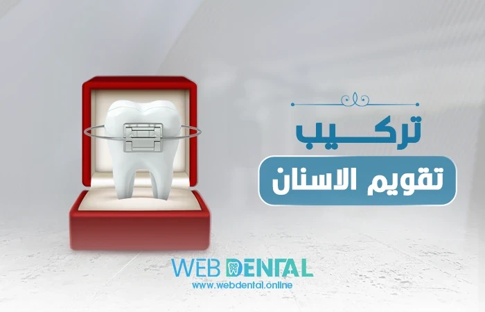 فوائد تركيب تقويم الاسنان وهل هو مؤلم image