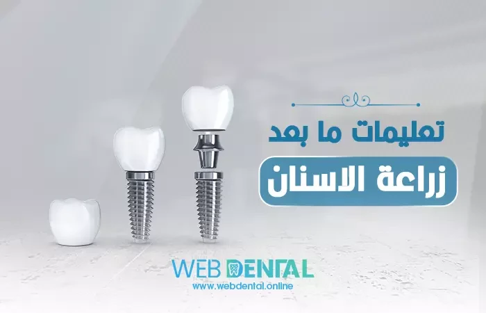 تعليمات ما بعد زراعة الاسنان image