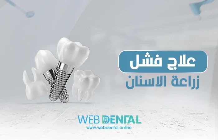 علاج فشل زراعة الاسنان image