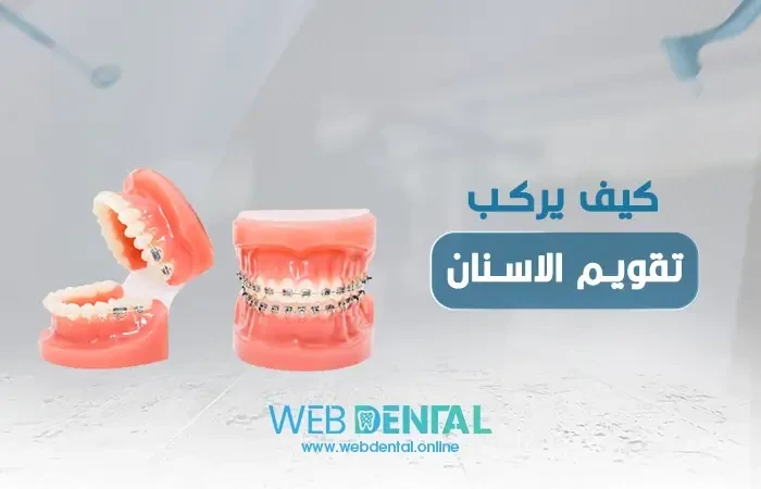 كيف يركب تقويم الاسنان image